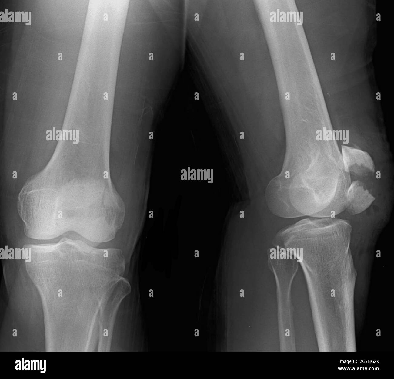 Broken knee cap, X-ray Stock Photo