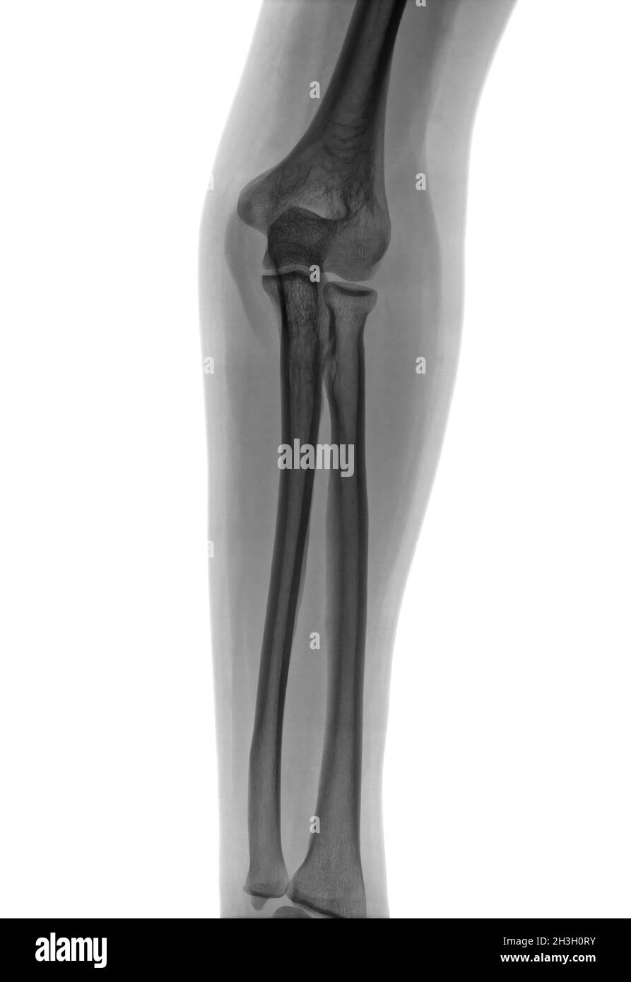 Elbow X-ray negative Stock Photo