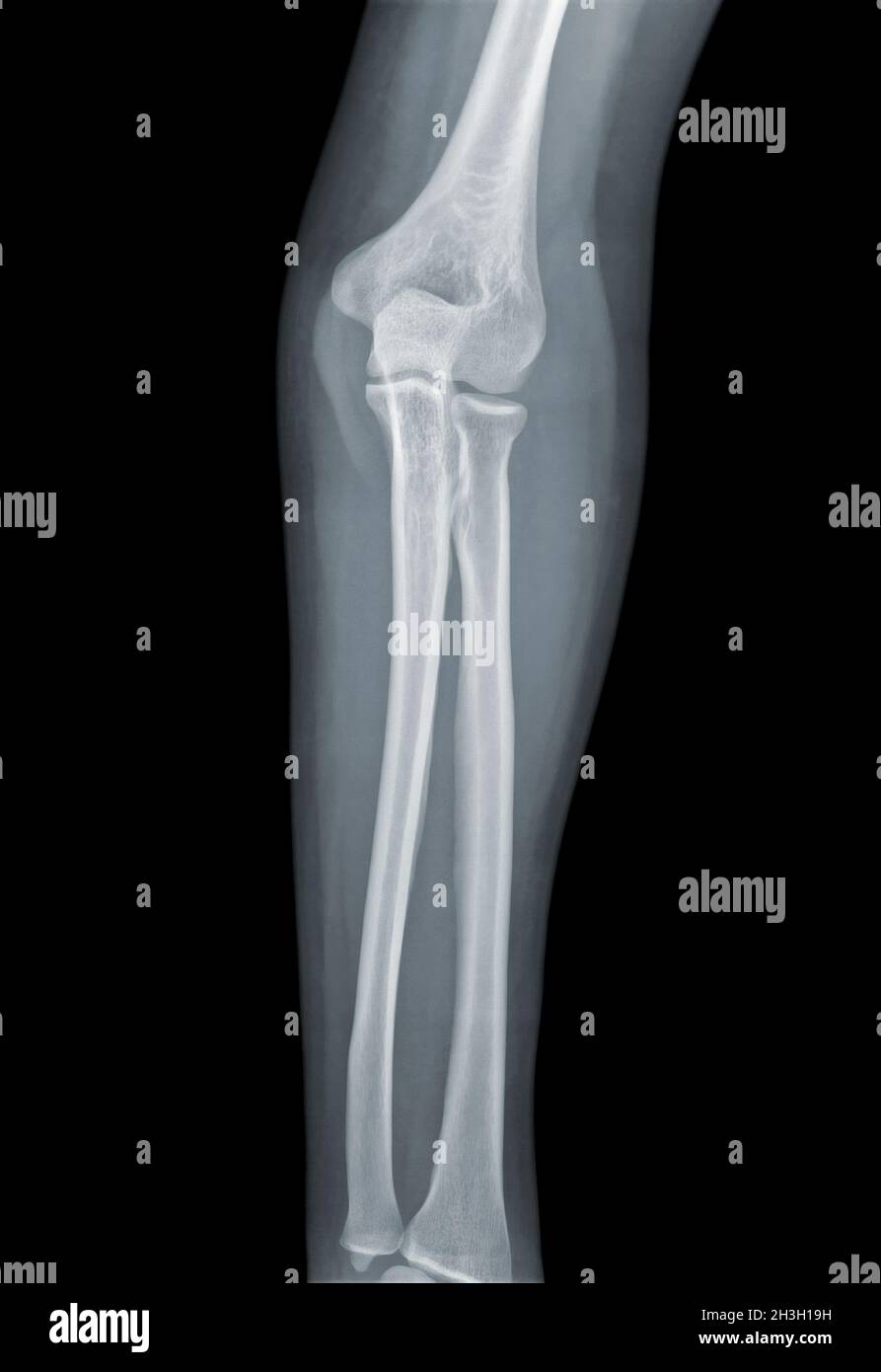 Elbow X-ray negative Stock Photo