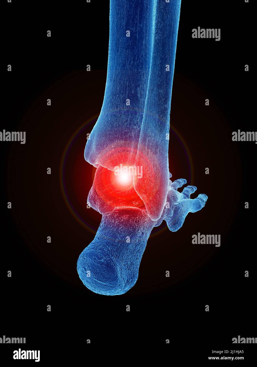 Painful ankle, illustration Stock Photo - Alamy