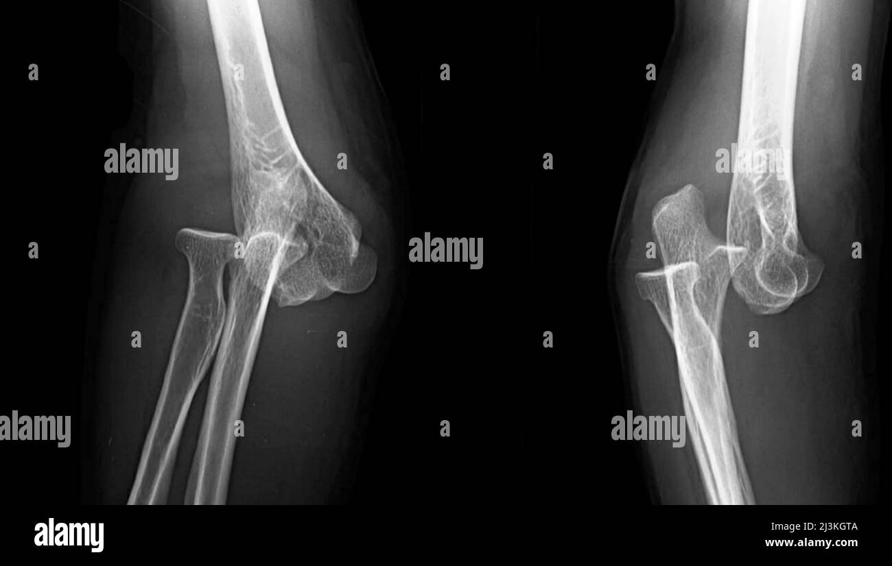 Dislocated elbow, X-ray Stock Photo