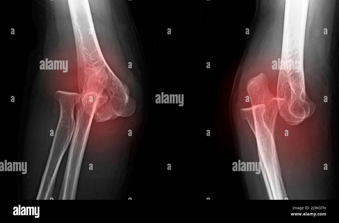 Dislocated elbow, X-ray Stock Photo