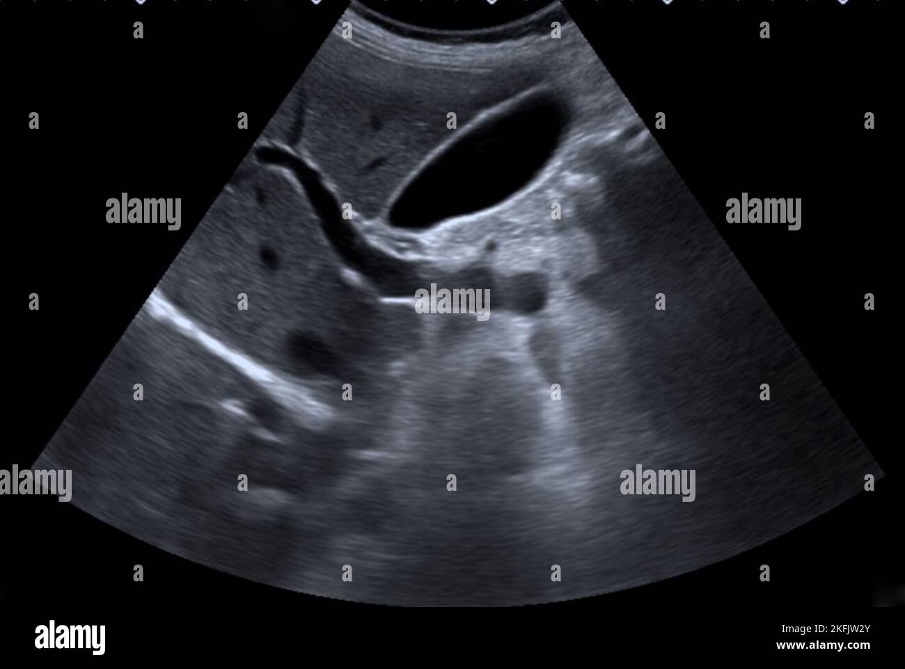 Abnormal Gallbladder Ultrasound Images