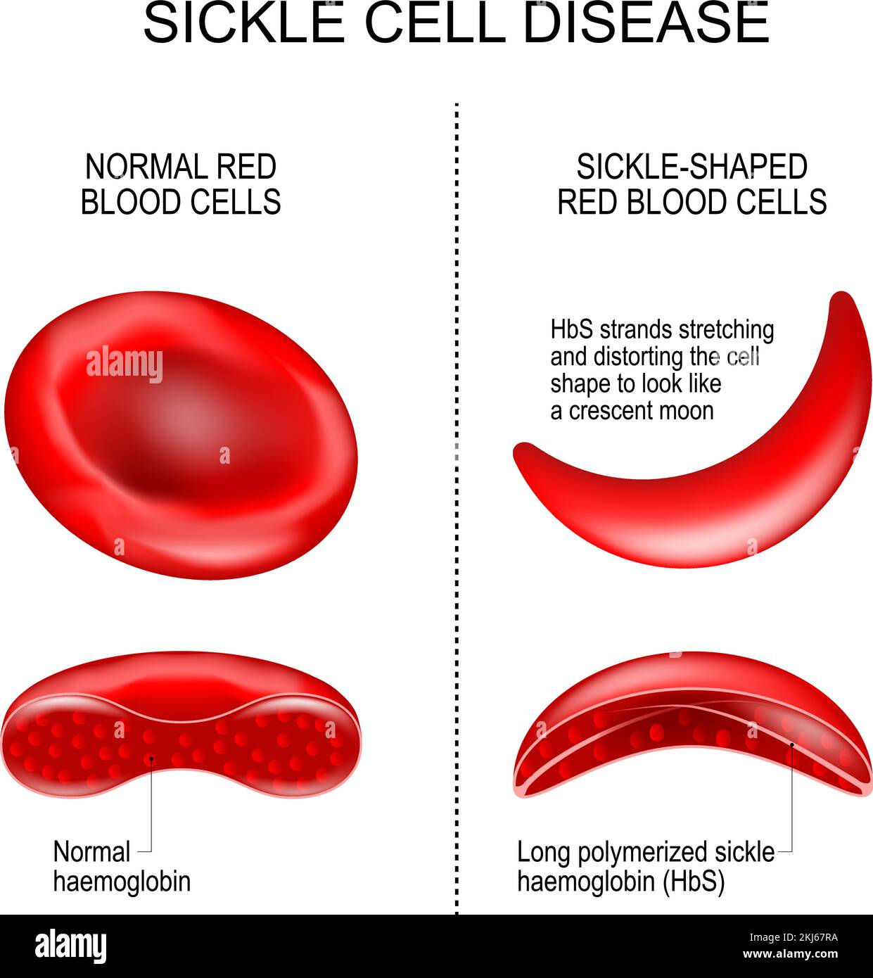 Sickle Cell Anemia Under Microscope