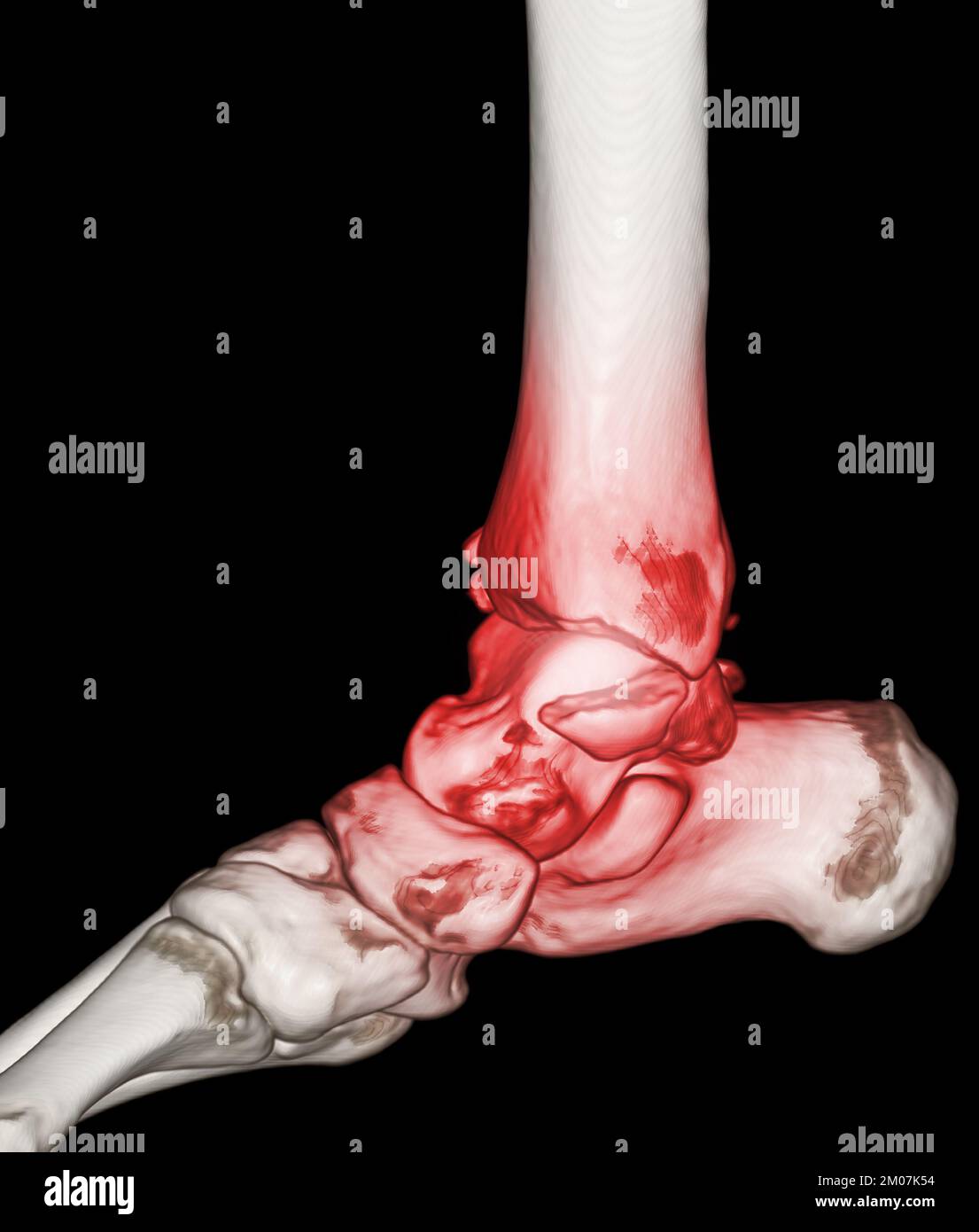 CT Scan ankle and foot or Computed Tomography of Ankle joint and Foot ...