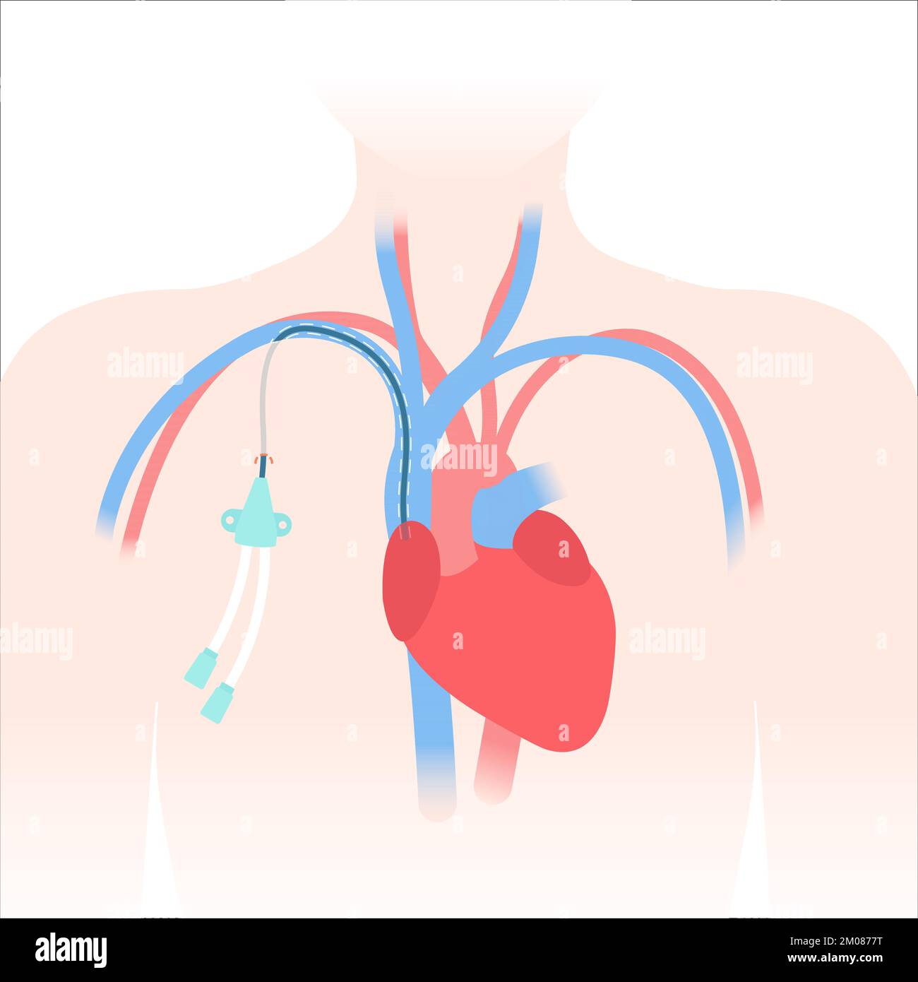 Tunneled Central Venous Catheter Placed In The Subclavian Vein Man ...