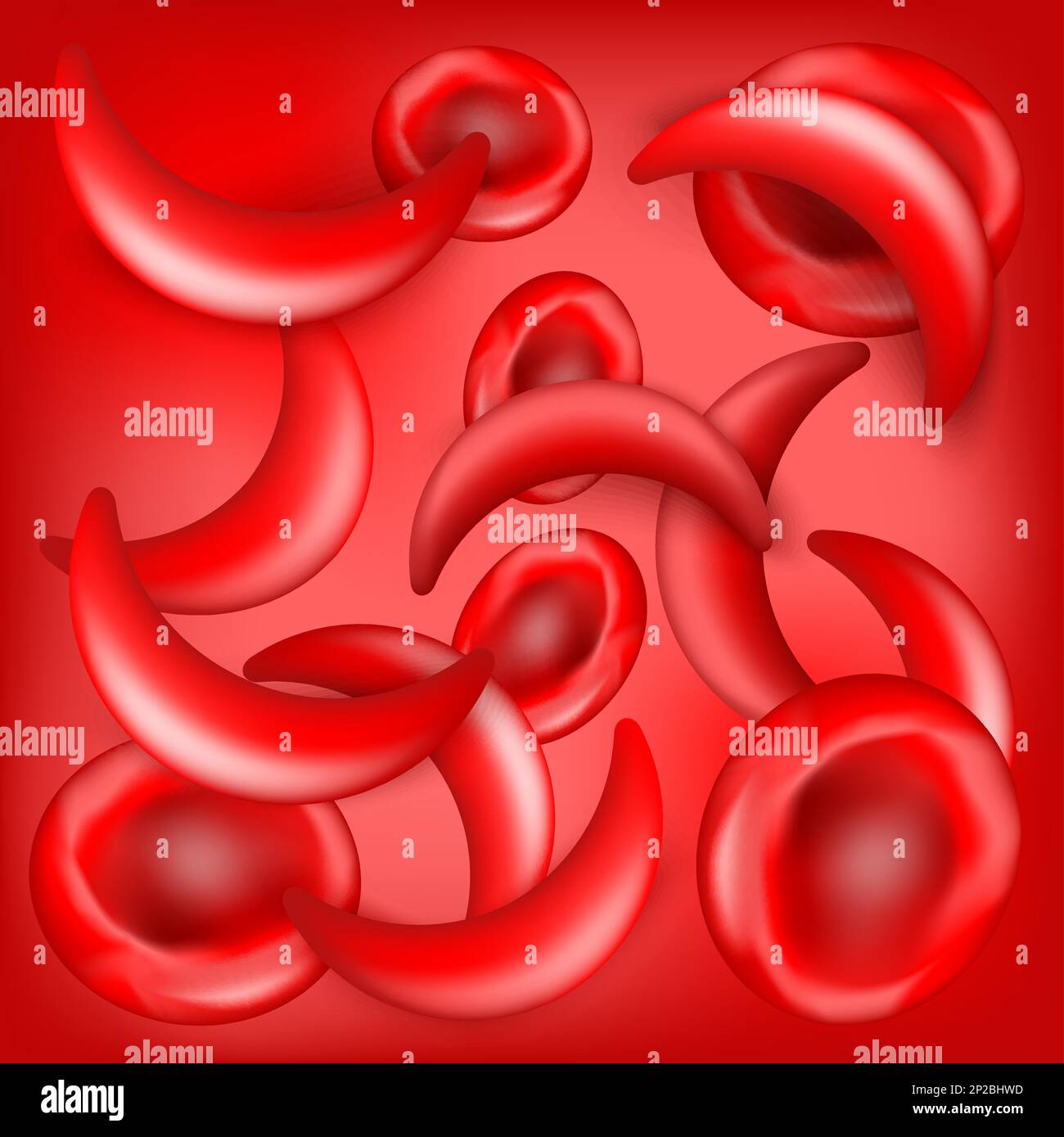 Sickle Cell Anemia Under Microscope