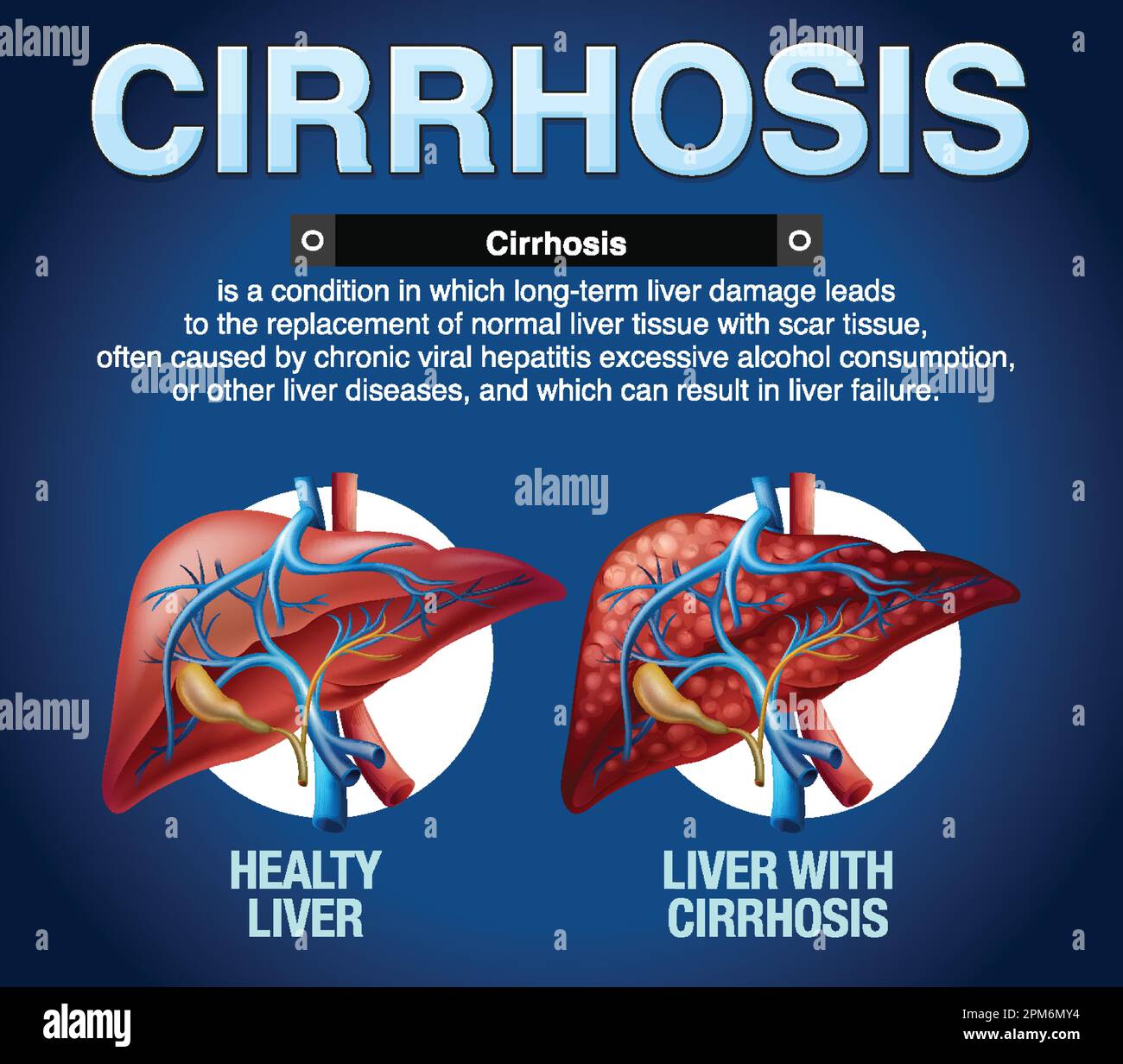 Cirrhosis of the Liver Infographic illustration Stock Vector Image ...