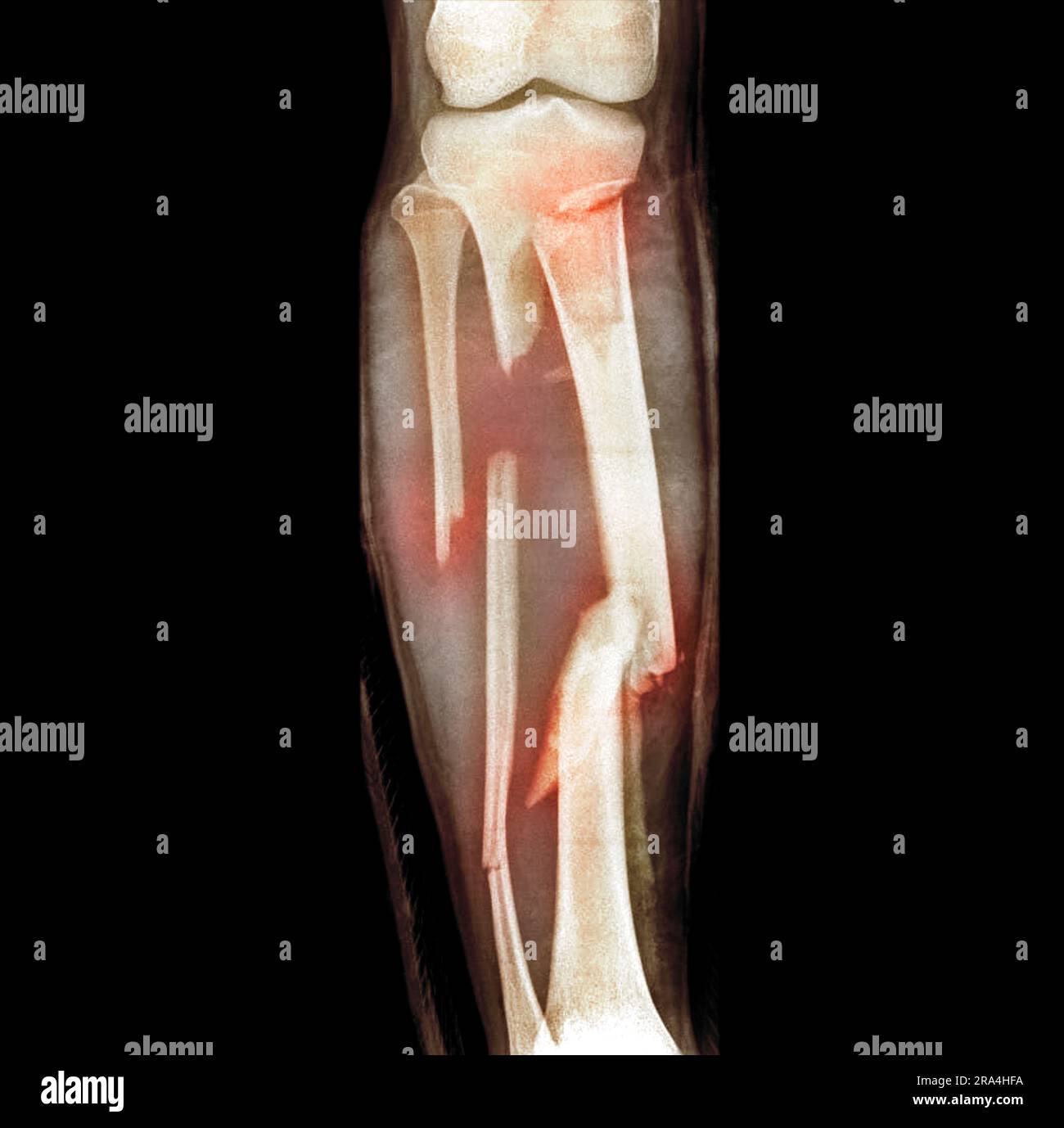 Fractured tibia hi-res stock photography and images - Alamy