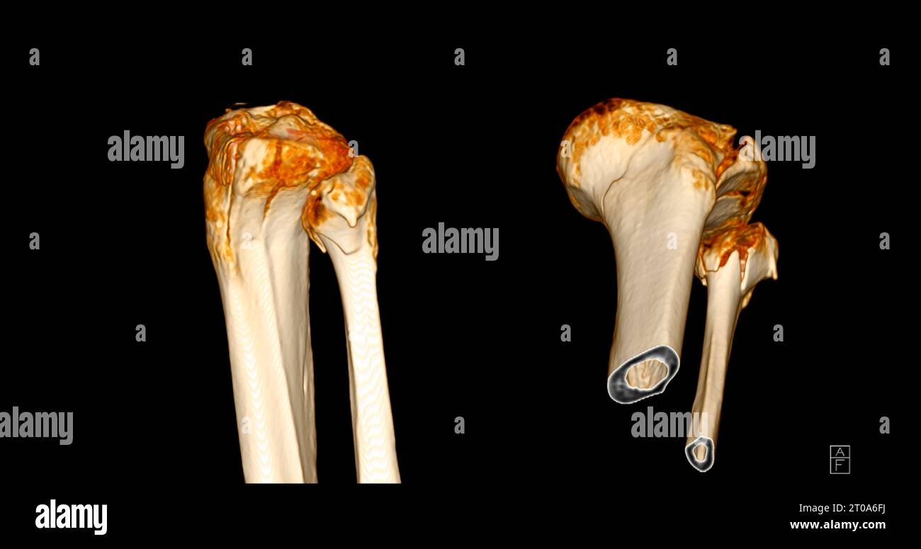 CT Scan of Knee joint showing fracture tibia and fibula bone 3D ...