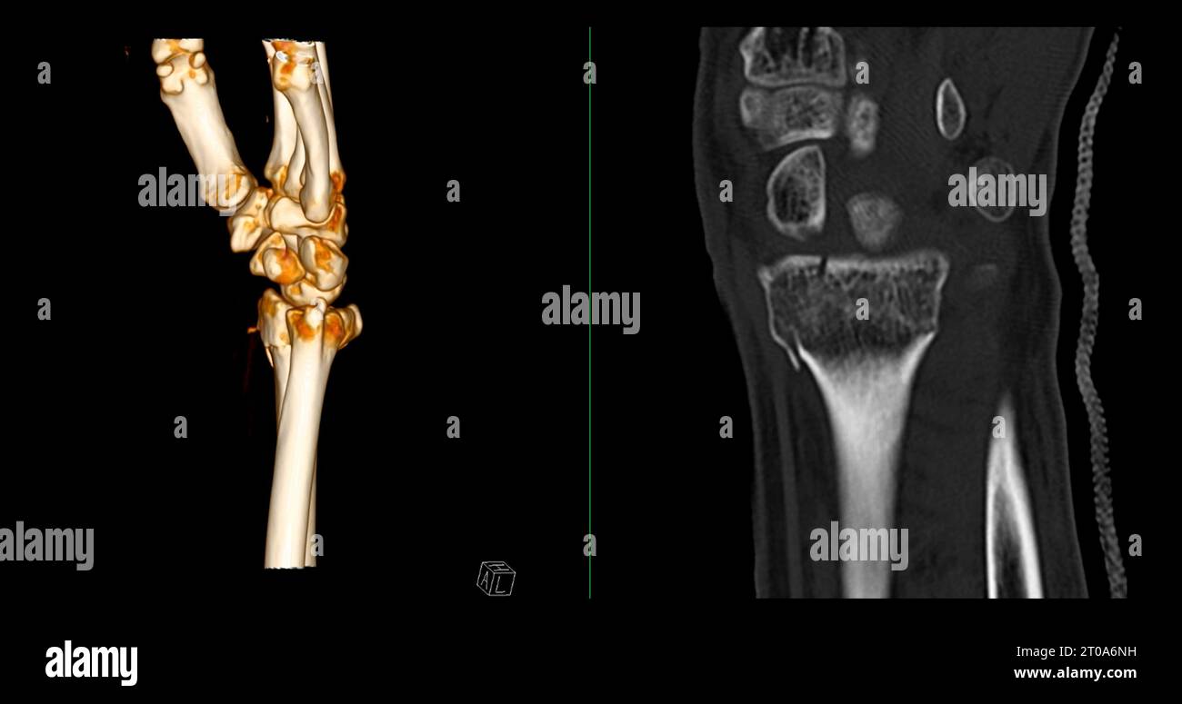 CT scan of wrist joint 3D rendering for diagnosis wrist joint pain ...