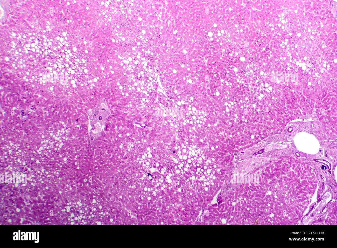 Photomicrograph of hepatic steatosis, revealing fat accumulation in ...