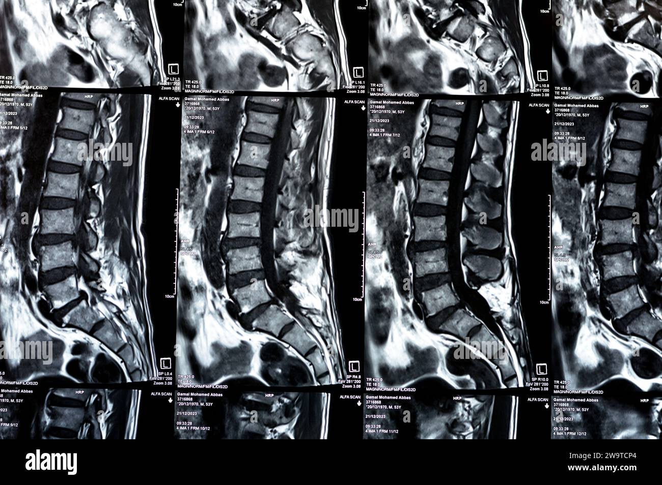 Cairo, Egypt, December 24 2023: L5 Vertebrae Spinal laminectomy evidence, posterior thecal sac decompression, lumbar spondylosis, posterior disc protr Stock Photo