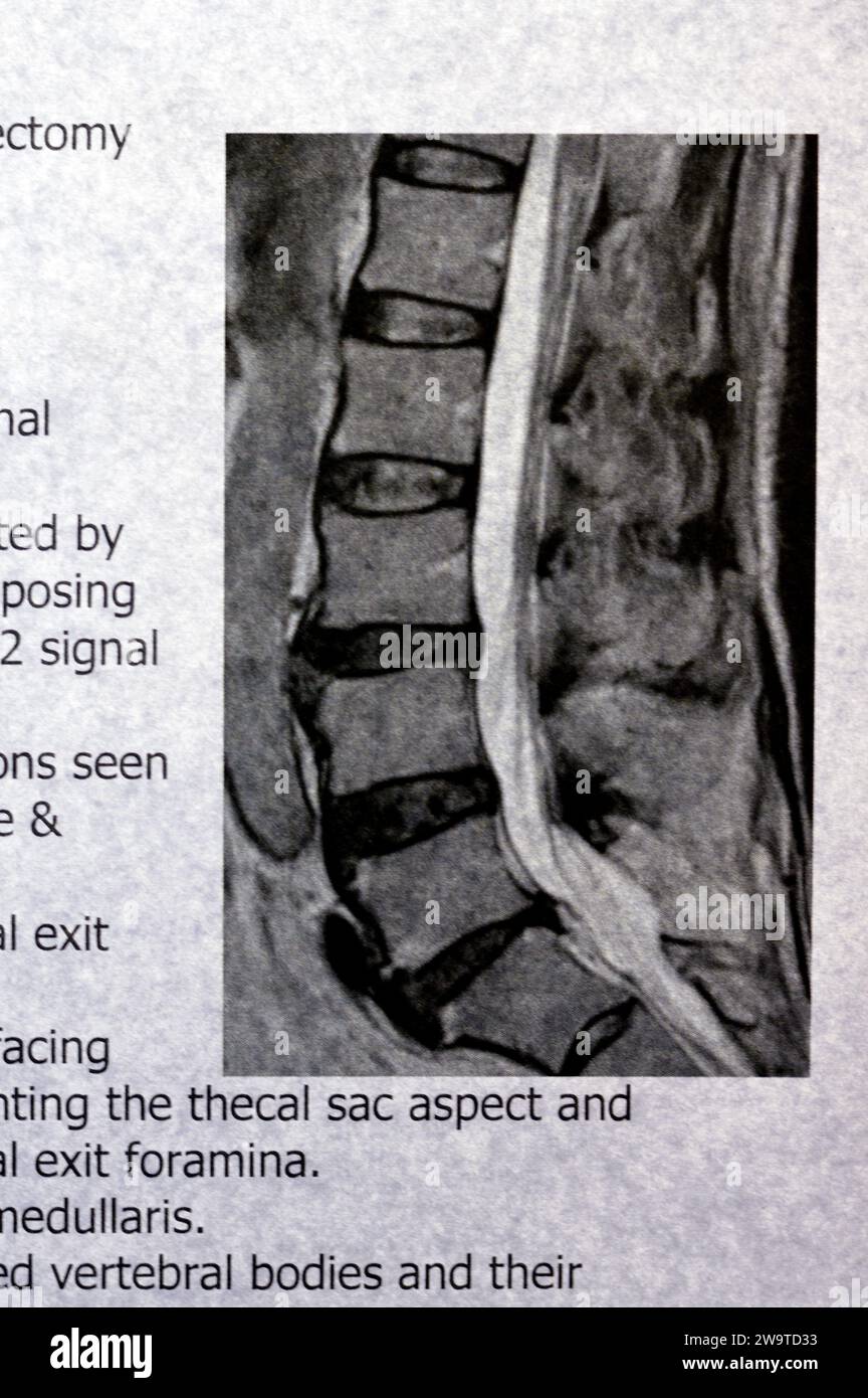 MRI lumbosacral spine shows L5 Vertebrae Spinal laminectomy evidence, posterior thecal sac decompression, lumbar spondylosis, posterior disc protrusio Stock Photo