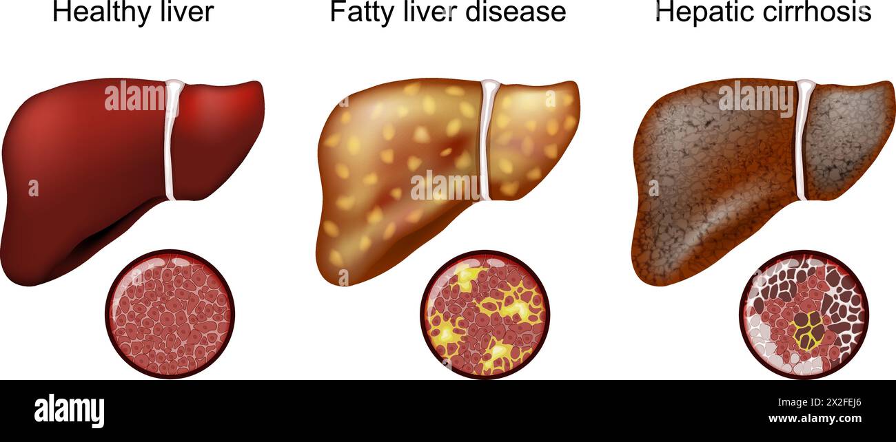 Fatty liver disease. Hepatic cirrhosis. Close-up of histology ...