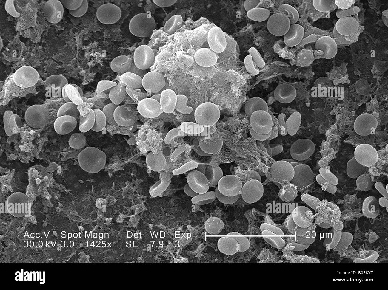 scanning electron microscope image of a blood clot showing red cells and fibrin coagulum Stock Photo