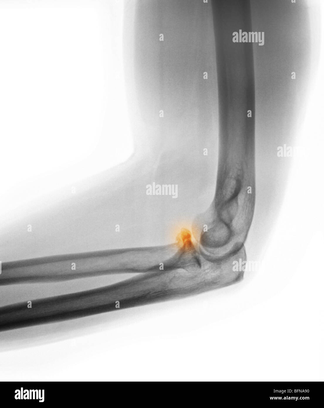 elbow x-ray showing a fracture of the head of the radius Stock Photo