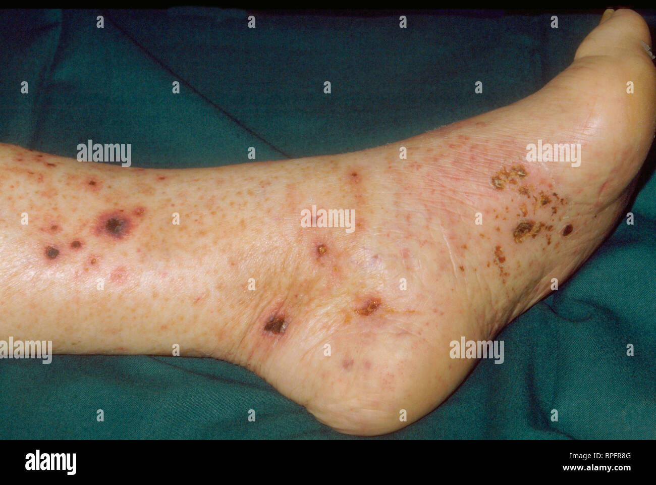 The leg and foot of a patient with inflammation of the blood vessels. Stock Photo