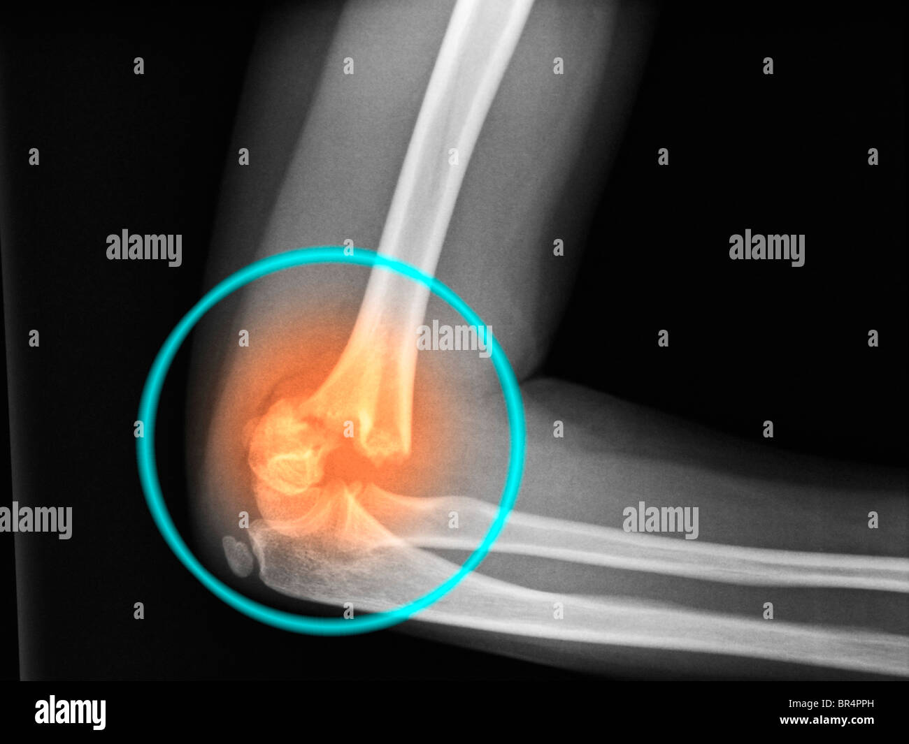 Elbow x-ray of an 8 year old female showing a badly displaced fracture of the distal humerus Stock Photo