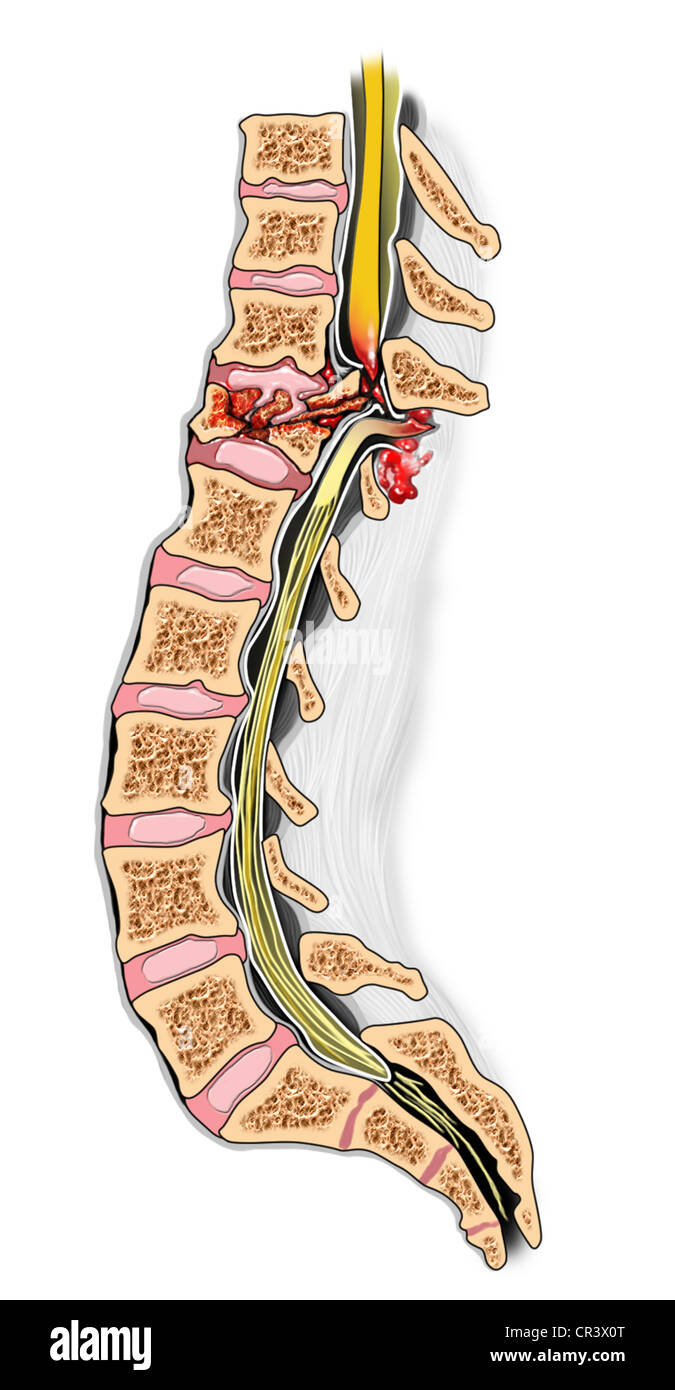 Thoracic Burst Fracture