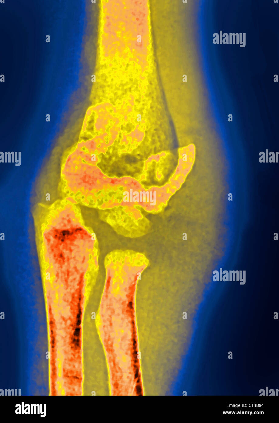 FRACTURED ELBOW, X-RAY Stock Photo