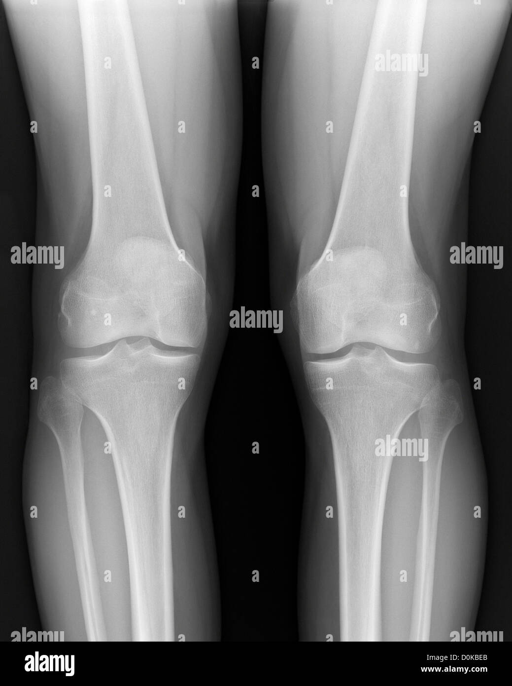 An x-ray human legs knees femur (or thighbone) meeting fibula (the smaller leg bone) tibia. patella (knee cap) is shadow base Stock Photo