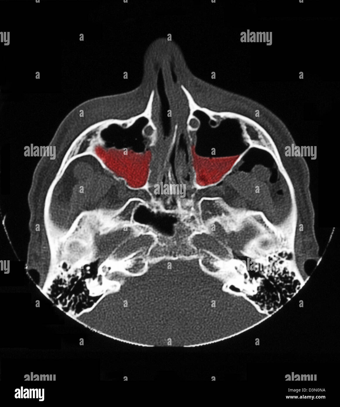 Medial Wall Of Maxillary Sinus