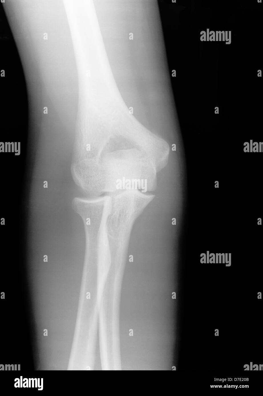 X-ray of a human elbow Stock Photo