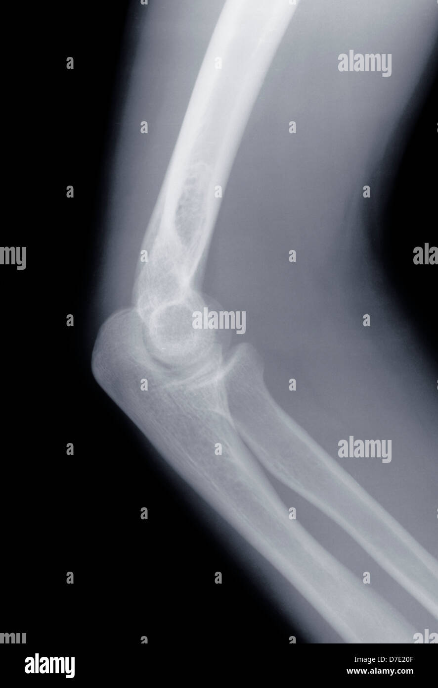 X-ray of a human elbow Stock Photo