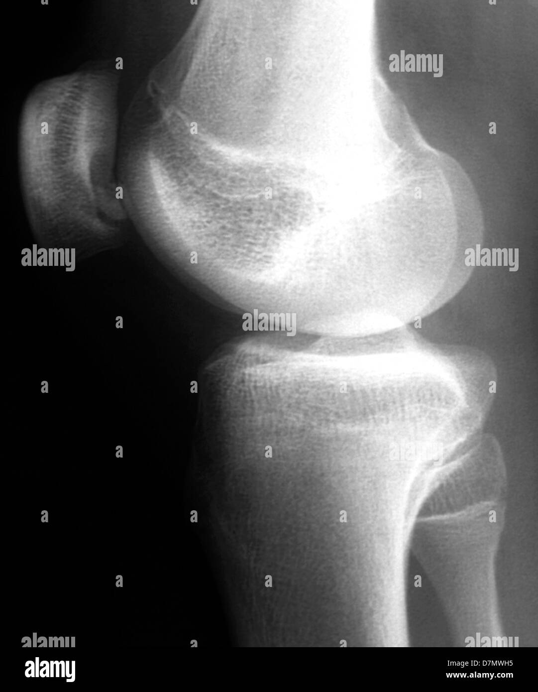 Knee disease, X-ray Stock Photo