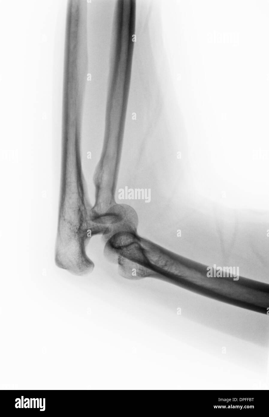 x-ray of an elbow dislocation Stock Photo