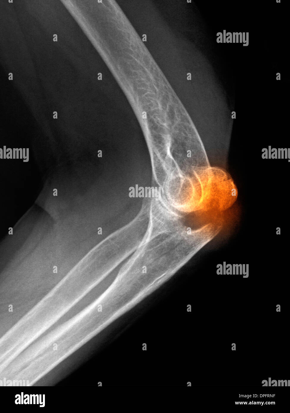 x-ray of an olecranon fracture Stock Photo