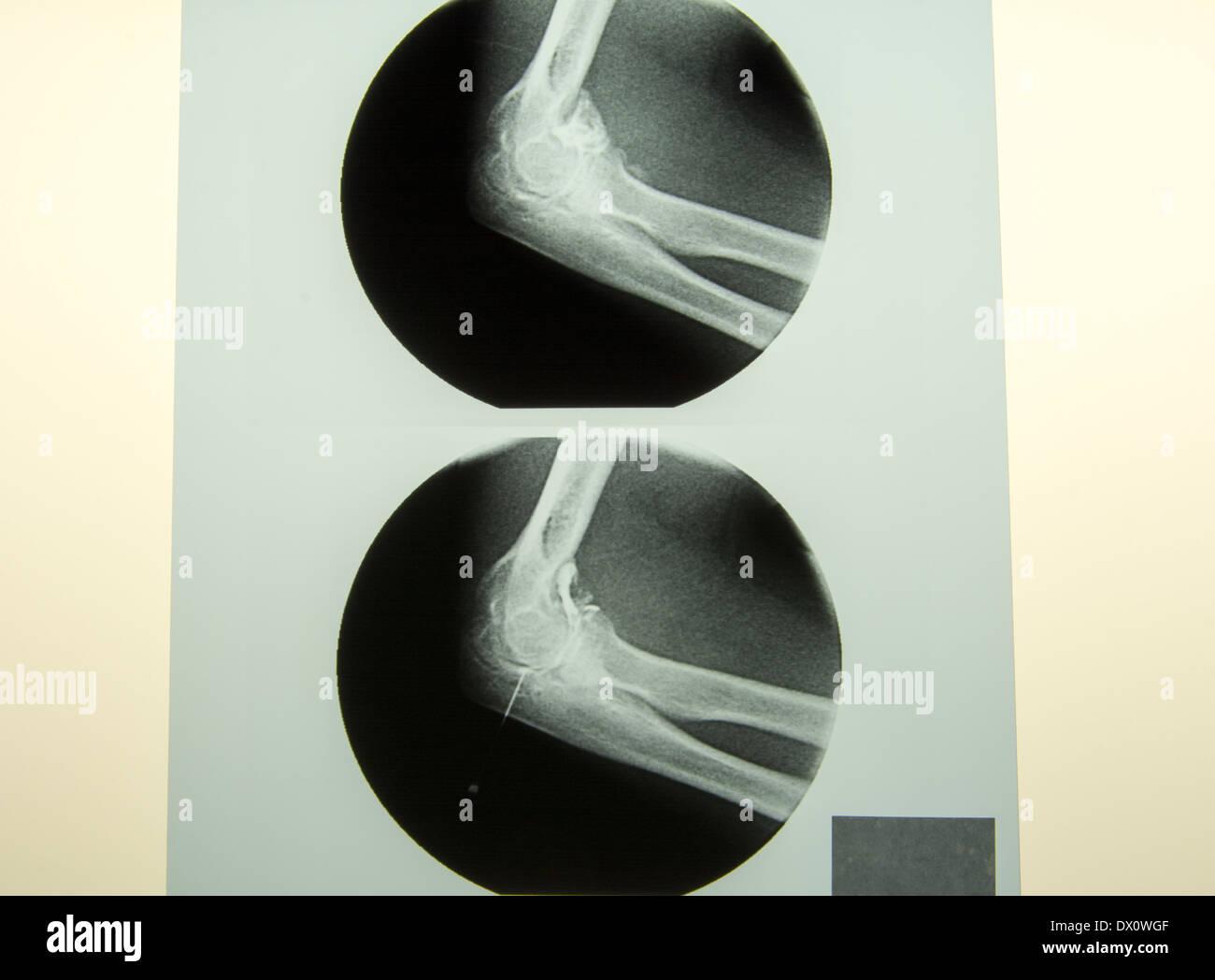 Needle X-RAY Stock Photo