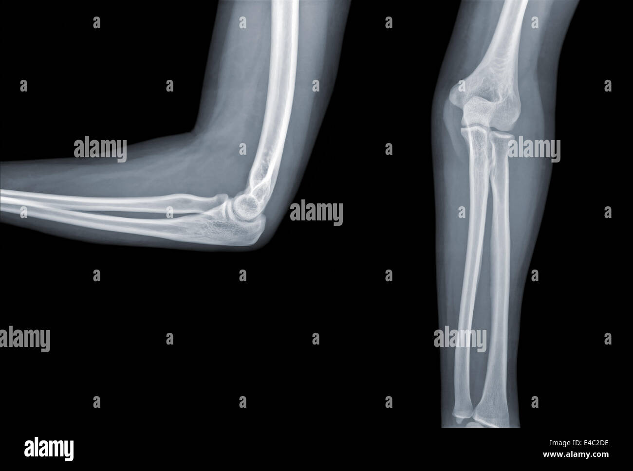 X-ray elbow Stock Photo