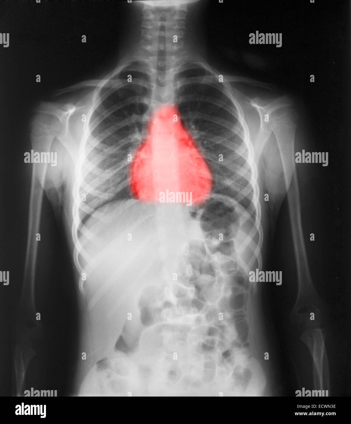 Normal Child Chest X Ray