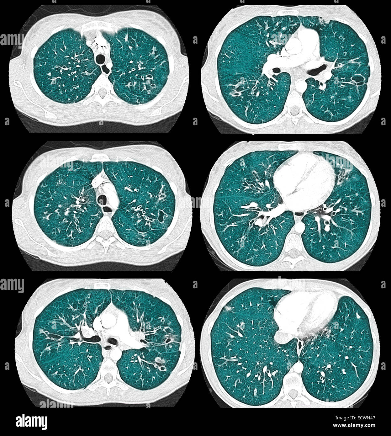 Lung Fibrosis CT Scan