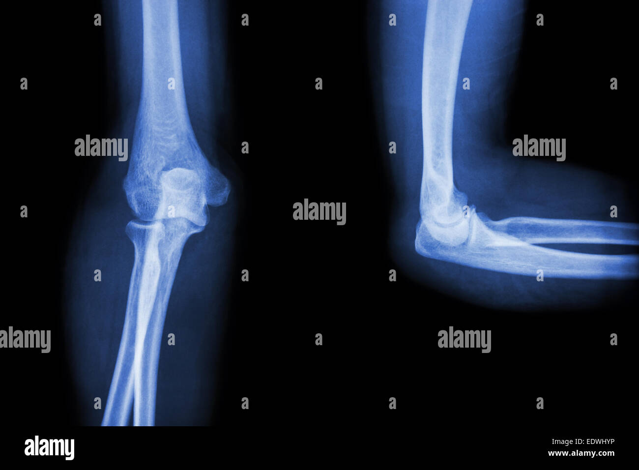 Film X-ray elbow AP(Antero-posterior)/lateral Stock Photo