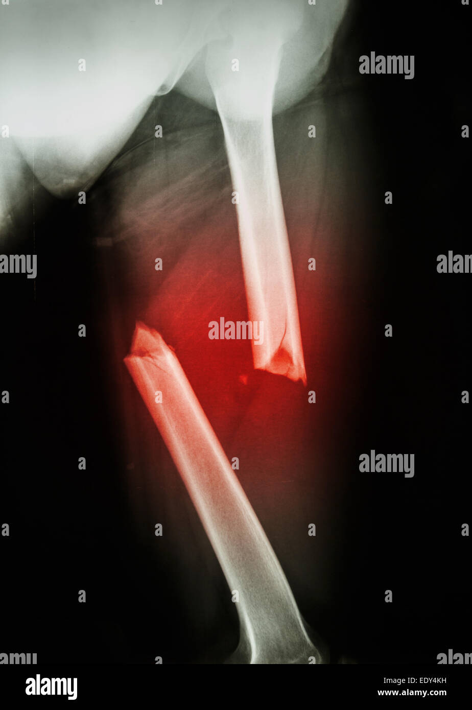 Xray Of The Femur Thigh Upper Legremakehealth