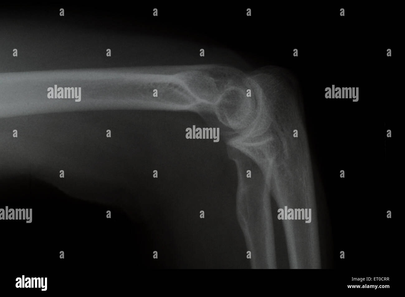 x ray af Elbow, side view for the Doctors exam Stock Photo