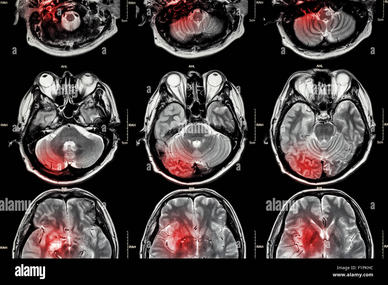 Resonancia Magnetica Cerebral