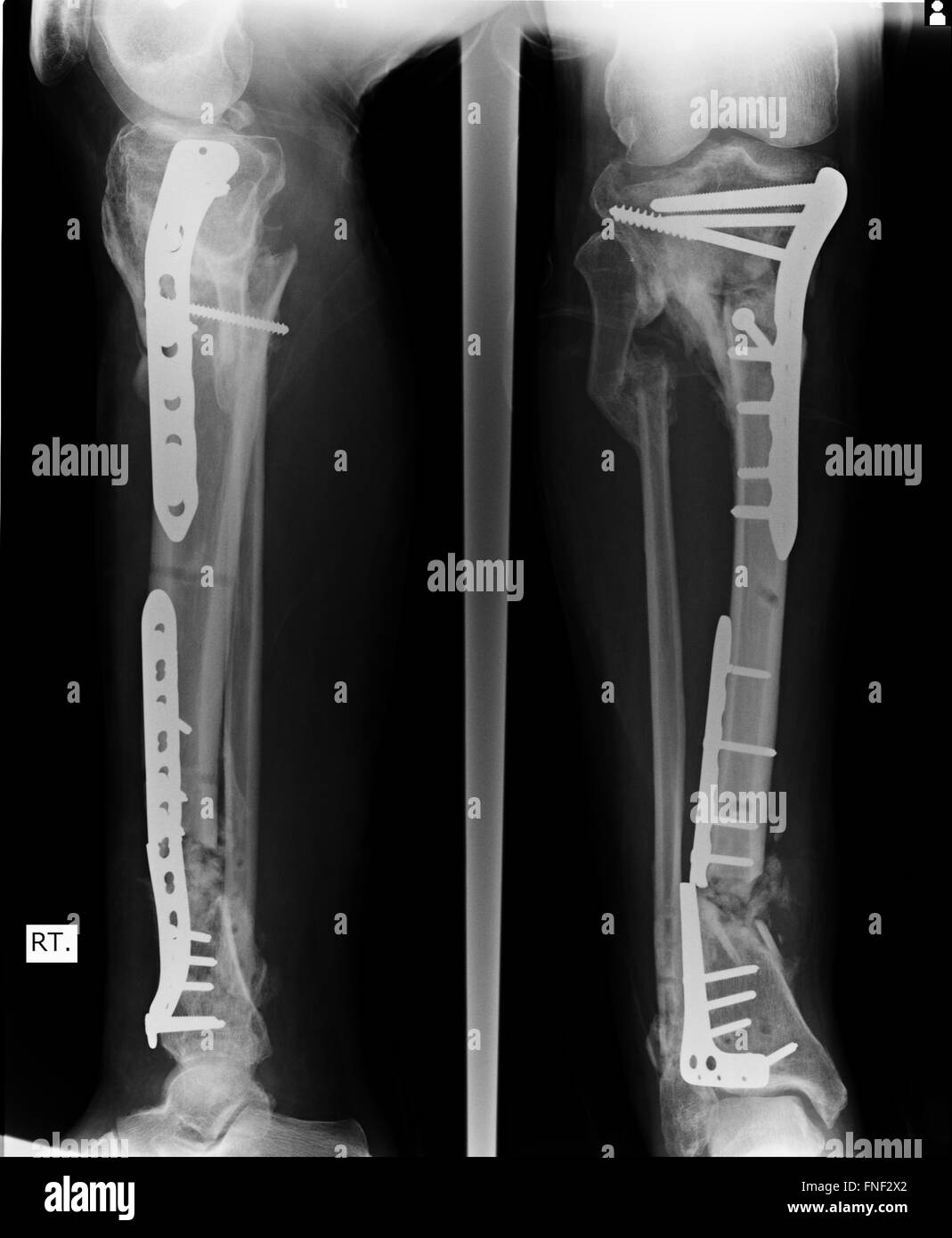 Fracture Elbow, forearm x-rays image showing plate and screw fixation Stock Photo