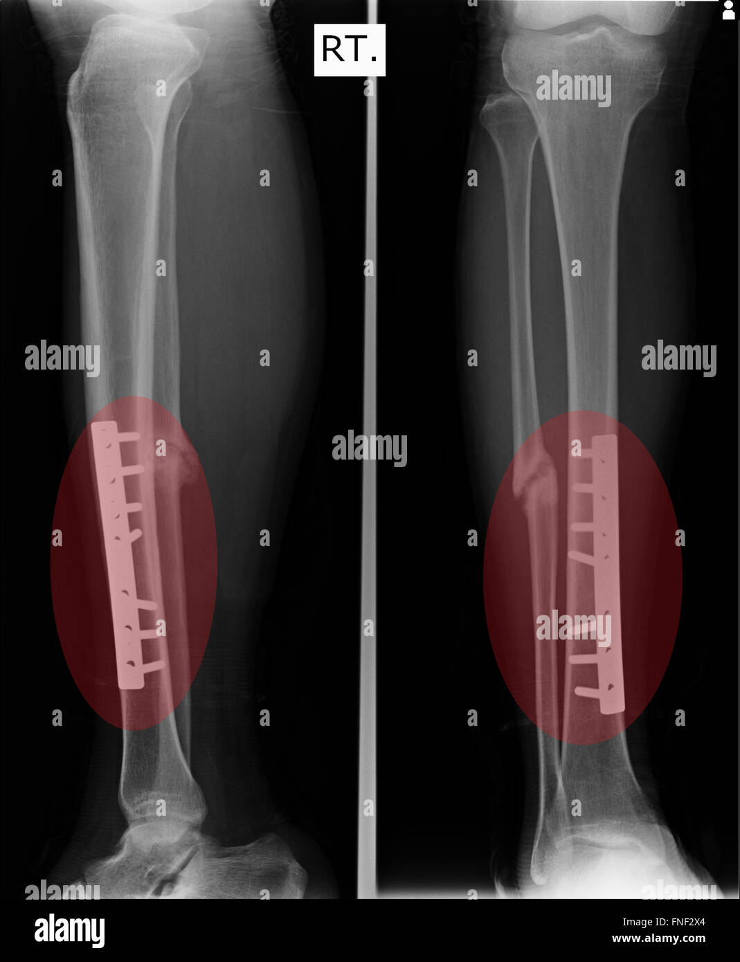 Fracture Elbow, forearm x-rays image showing plate and screw fixation Stock Photo