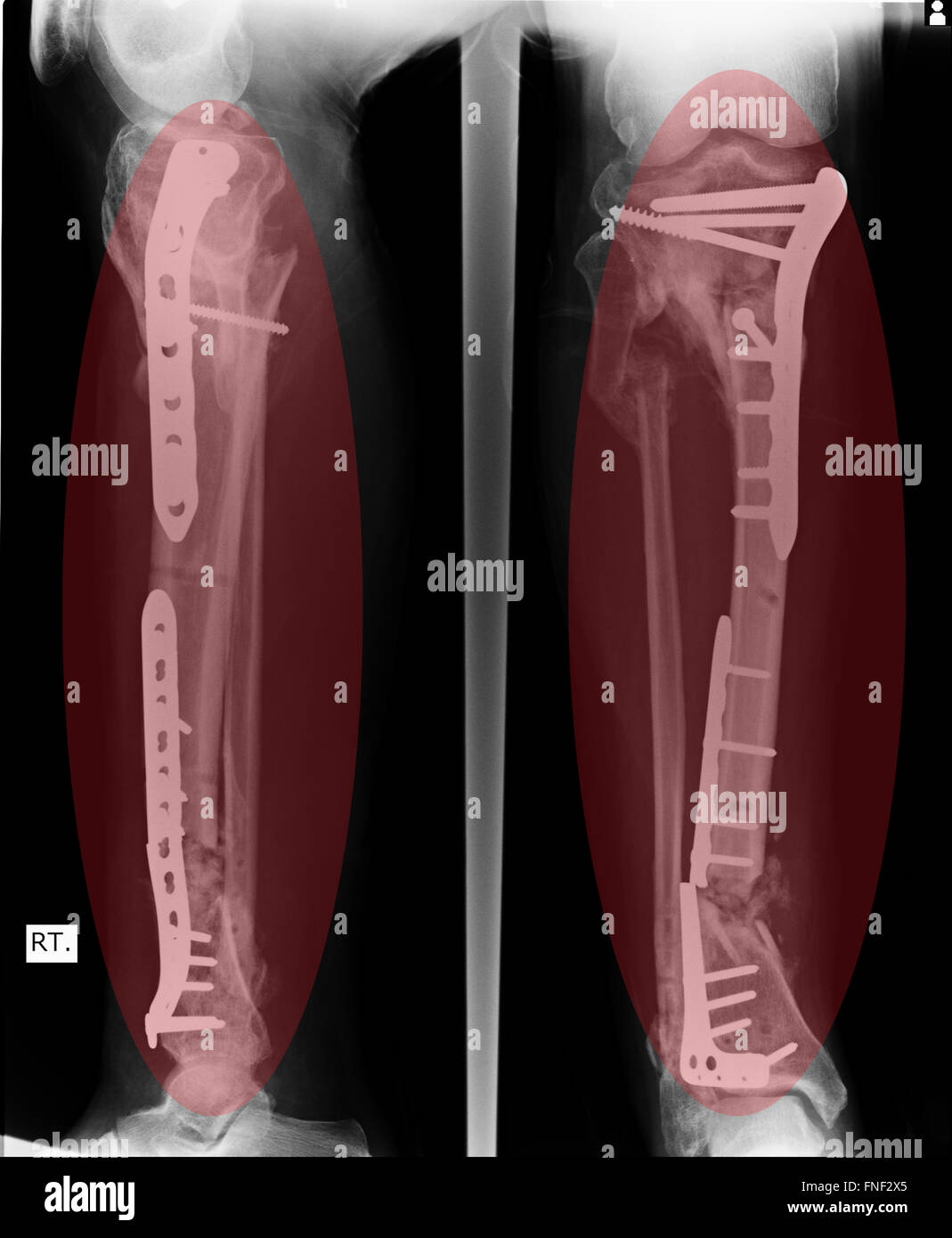 Fracture Elbow, forearm x-rays image showing plate and screw fixation Stock Photo