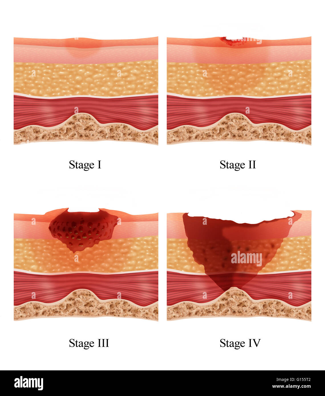 Stage 1 Pressure Ulcer Sacrum