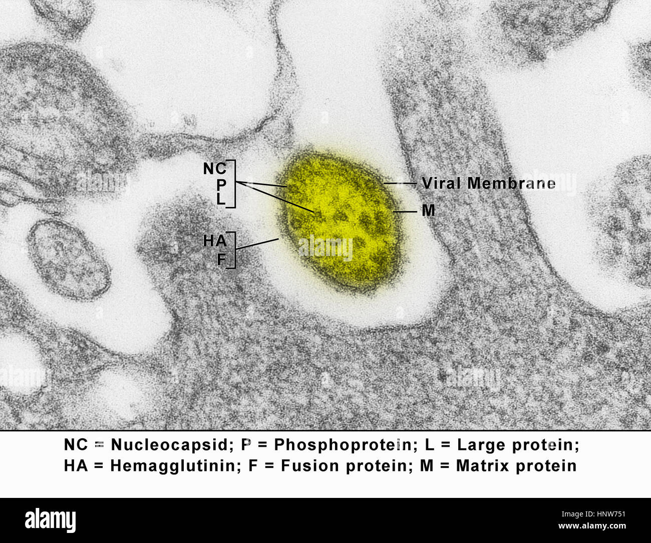 Transmission electron micrograph showing a measles virus particle, or virion Stock Photo