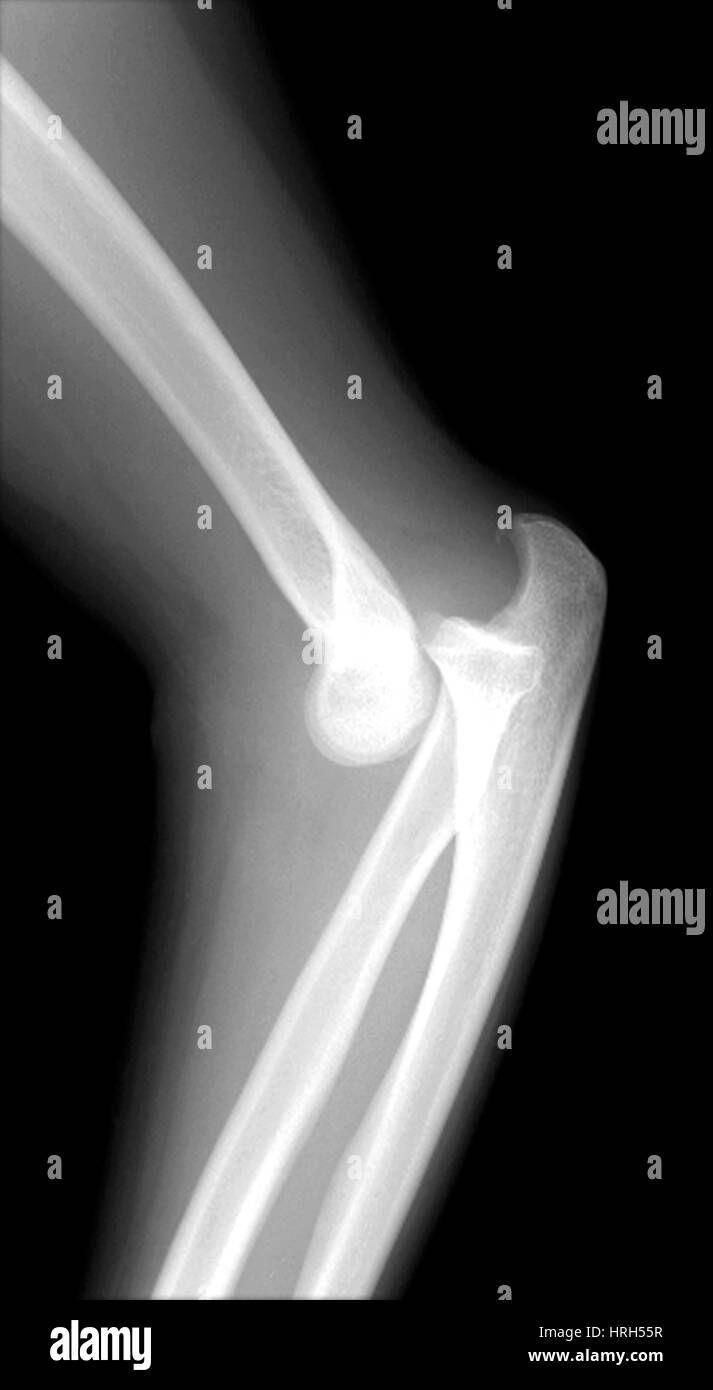 Lateral X-Ray of the Elbow Stock Photo