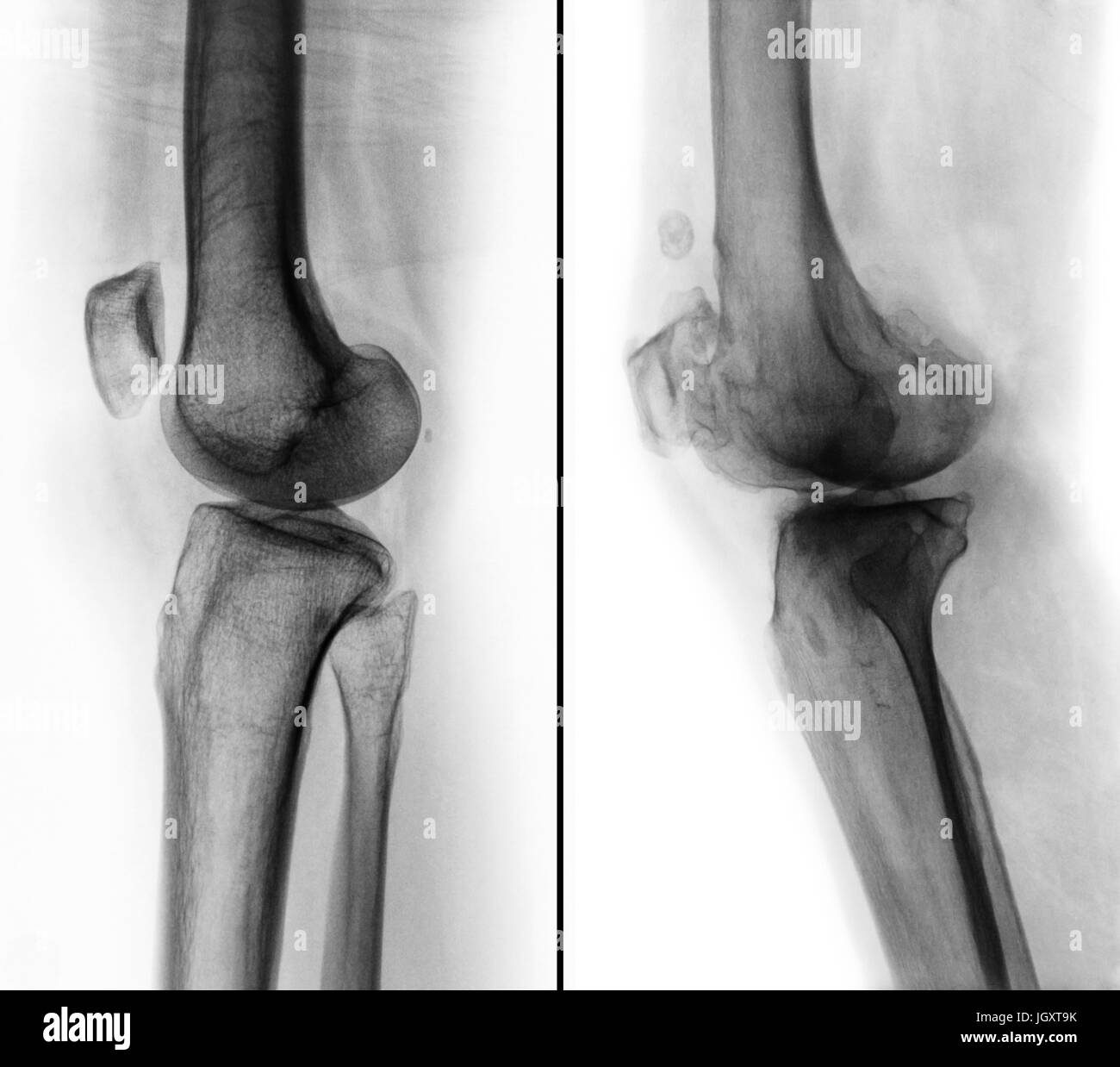 Comparison between normal human knee ( left image ) and osteoarthritis knee ( right image ) . Lateral view . Stock Photo