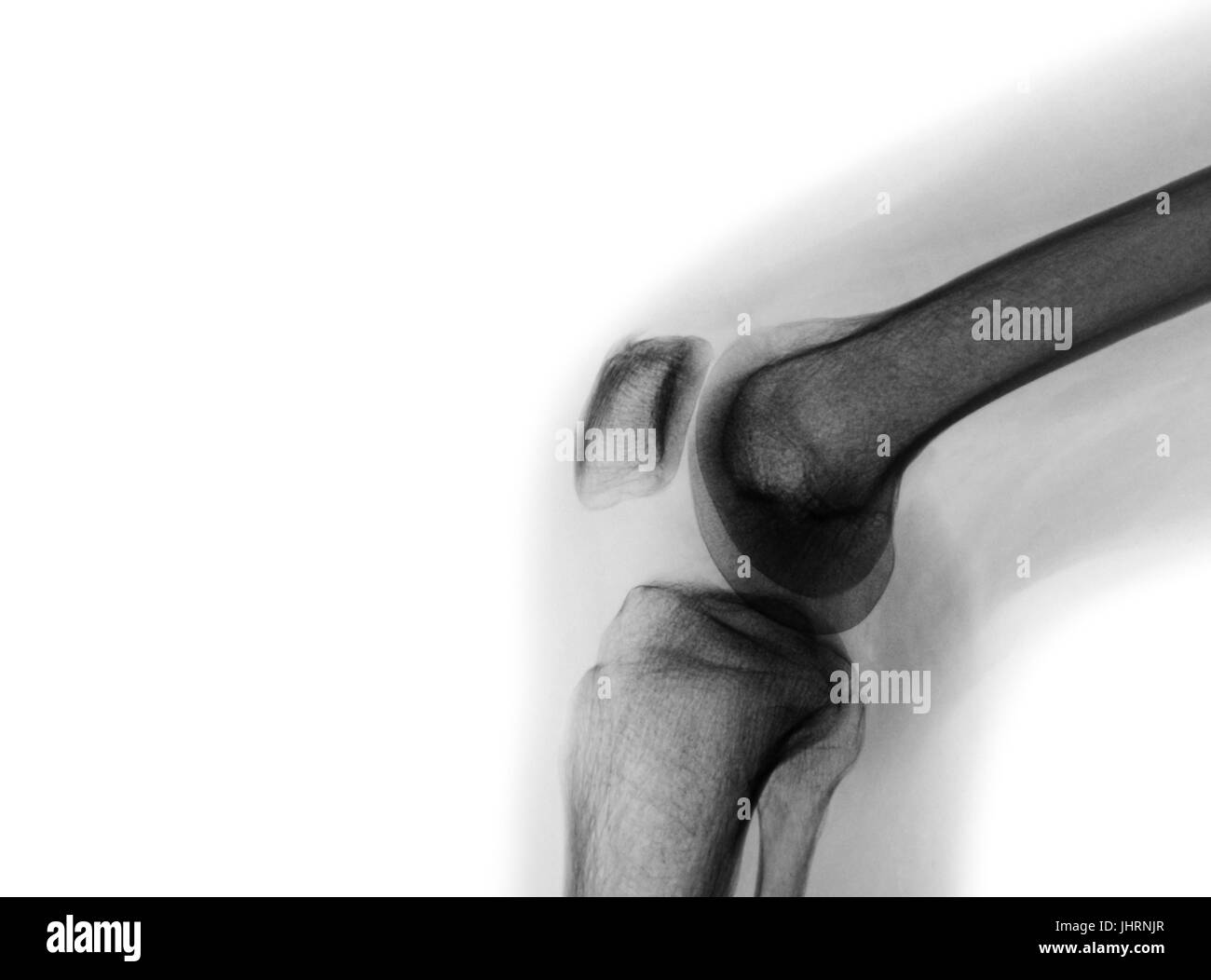 Film x-ray of normal knee joint and blank area at left side . Stock Photo