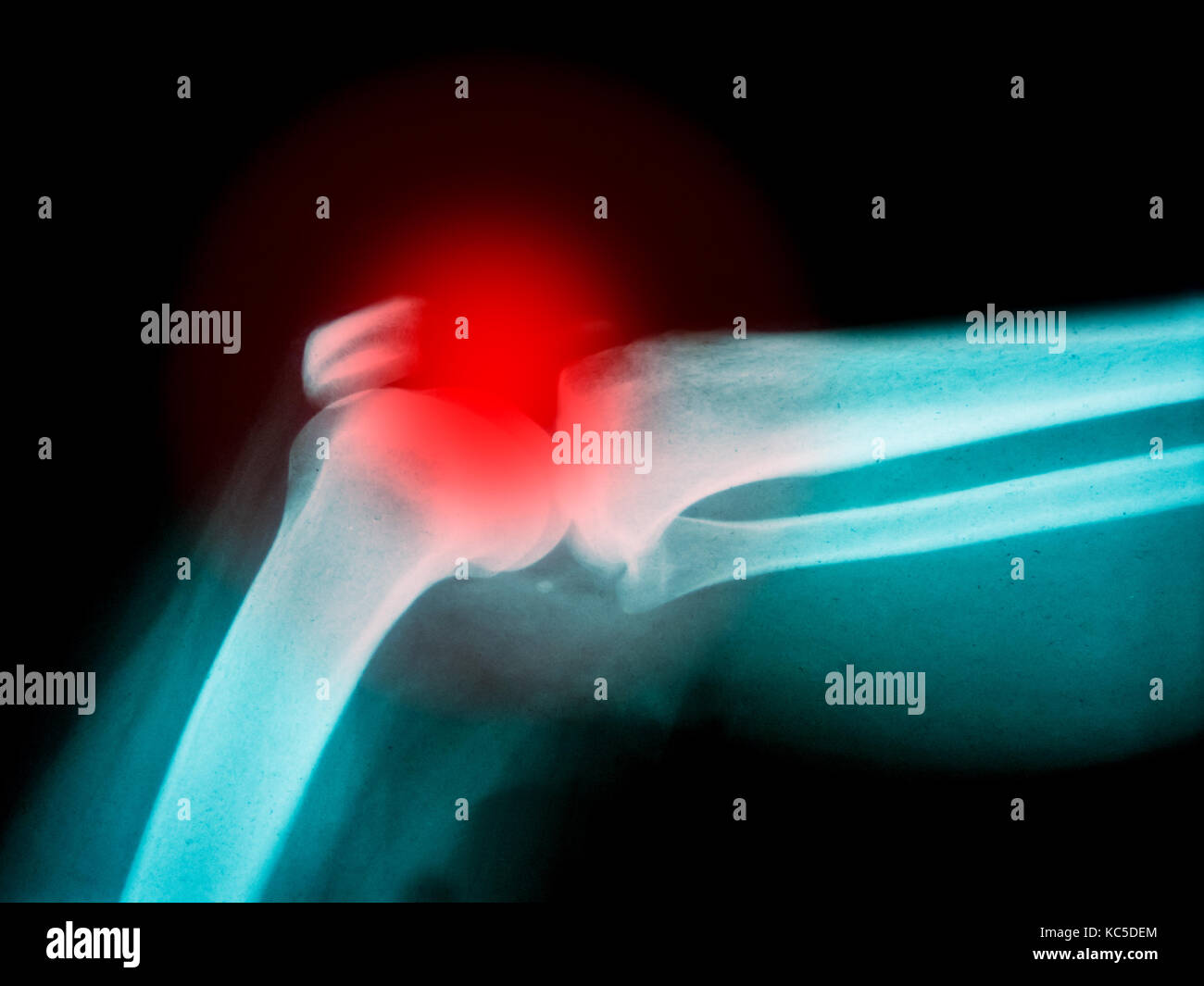 X-ray of human arm showing broken bone with red highlight Stock Photo