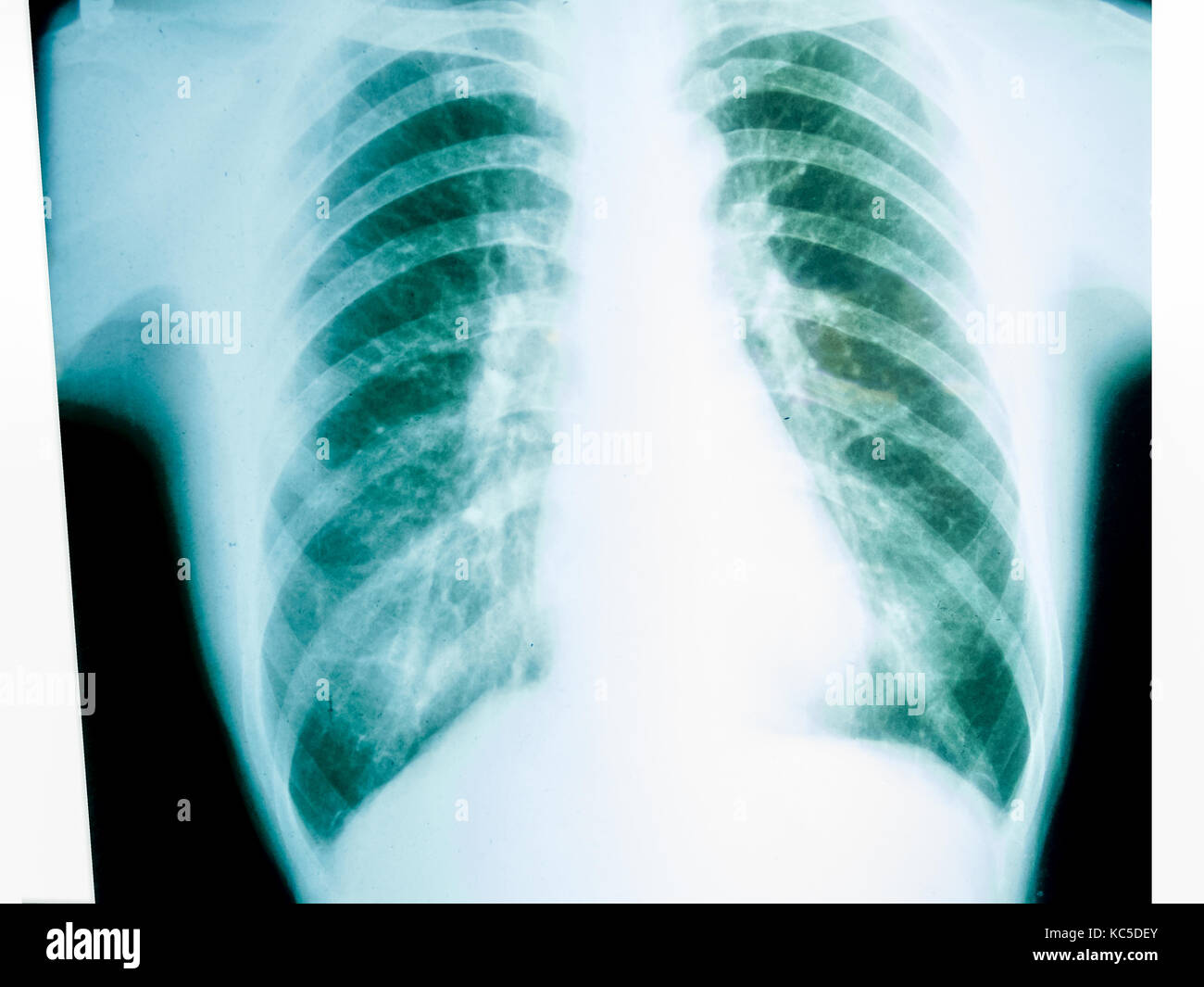 X-ray of a human male chest Stock Photo